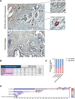 CD105 expression in cancer-associated fibroblasts: a biomarker for bone metastasis in early invasive ductal breast cancer patients